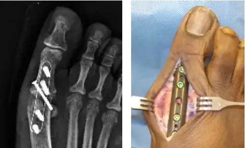 carbon fiber augmentation